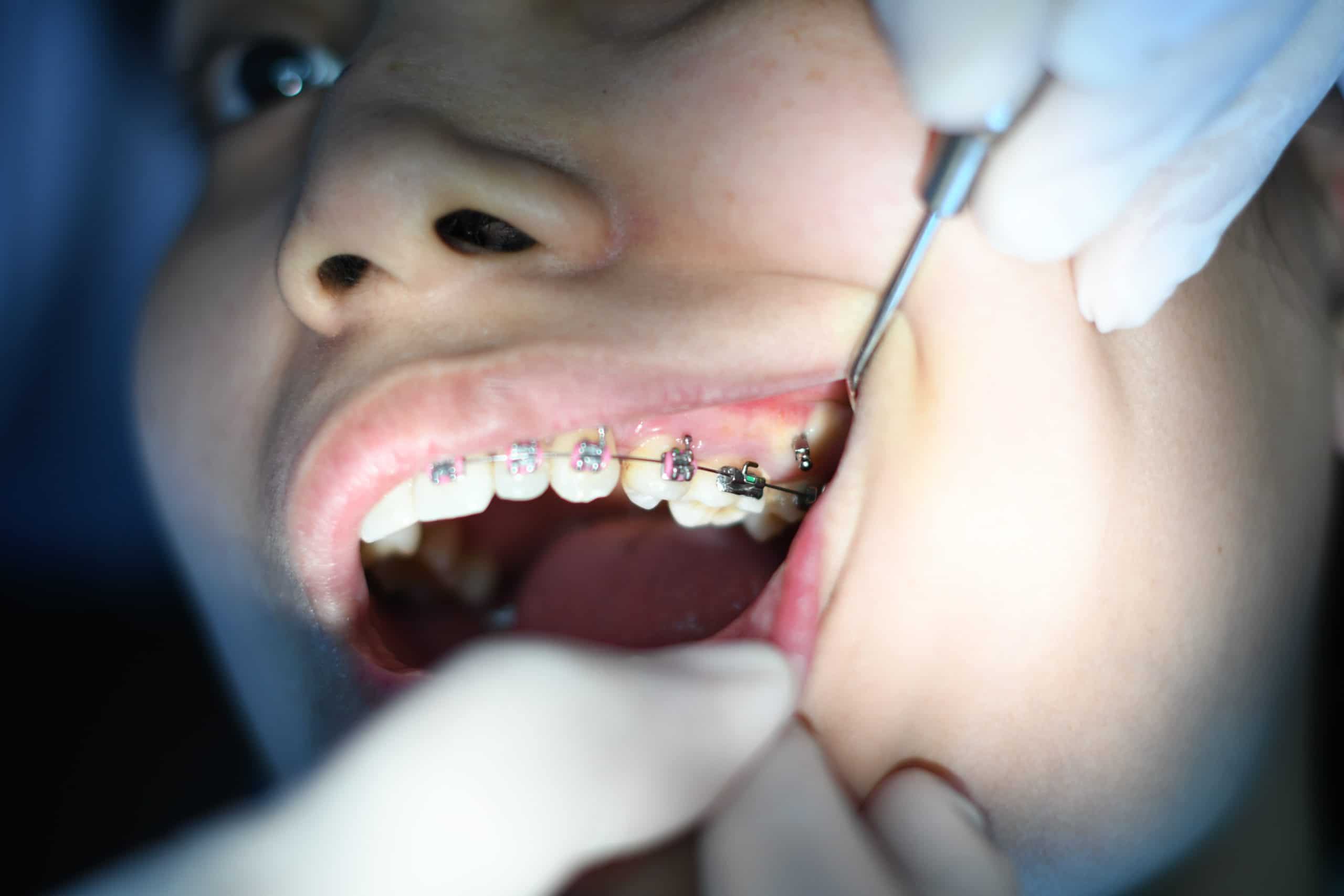 Tooth Extraction – the  final destination